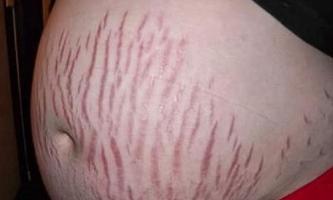 Elimine as estrias, cicatrizes e marcas na pele com um ingrediente inusitado
