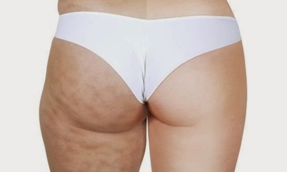 Sofre com a flacidez na pele? Conheça um creme caseiro que promete solucionar