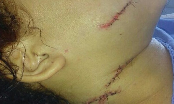 Permanece internada na Santa Casa, grávida que levou 21 facadas do ex namorado