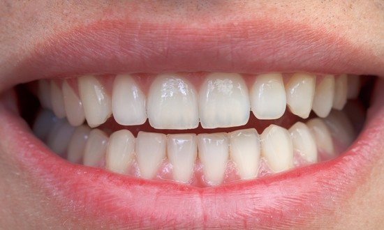 Aprenda uma fórmula caseira que ajuda a eliminar o tártaro dos dentes