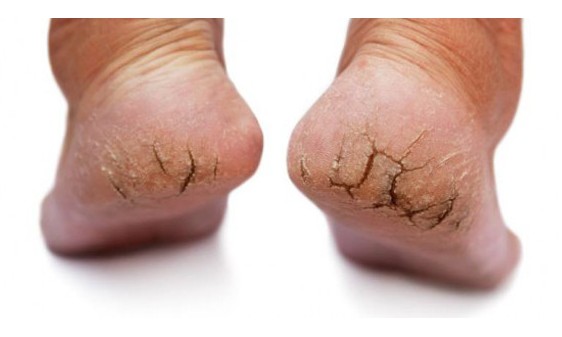 Sofre com pés rachados? Veja como solucionar o problema definitivamente