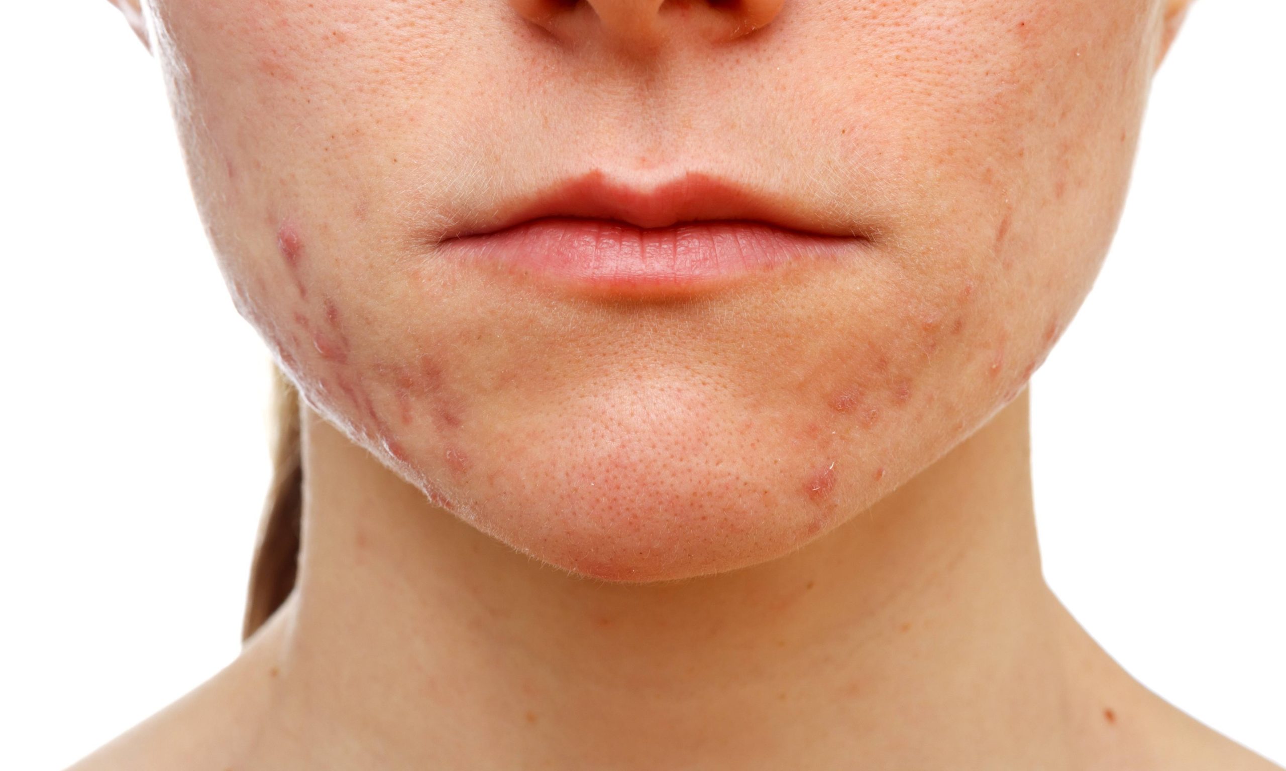Sofre com acne e espinha? Trate o problema com folha de goiabeira