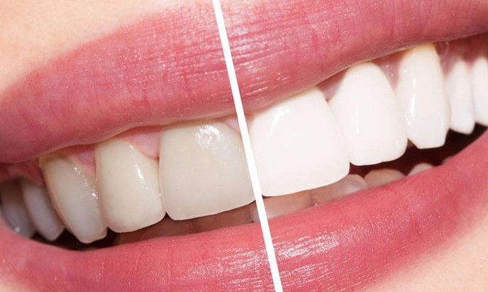 Aperfeiçoamento de técnicas proporciona dentes mais brancos em minutos