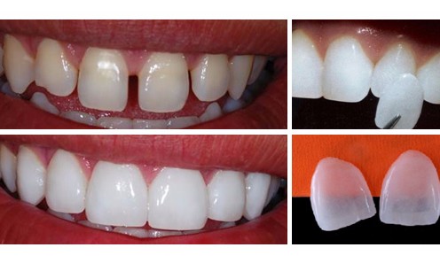Assim como os olhos, os dentes também precisam de lentes de contato