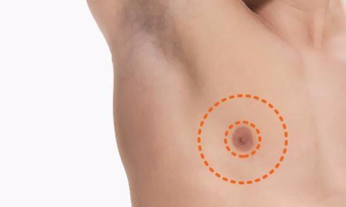 Cirurgia plástica de redução de mamilos é nova tendência para este ano