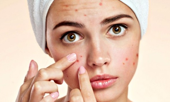 Espinhas? Chocolate não é o grande vilão da Páscoa, explica dermatologista