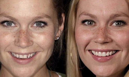 Lentes de contato para os dentes mudam aparência e podem durar até 15 anos