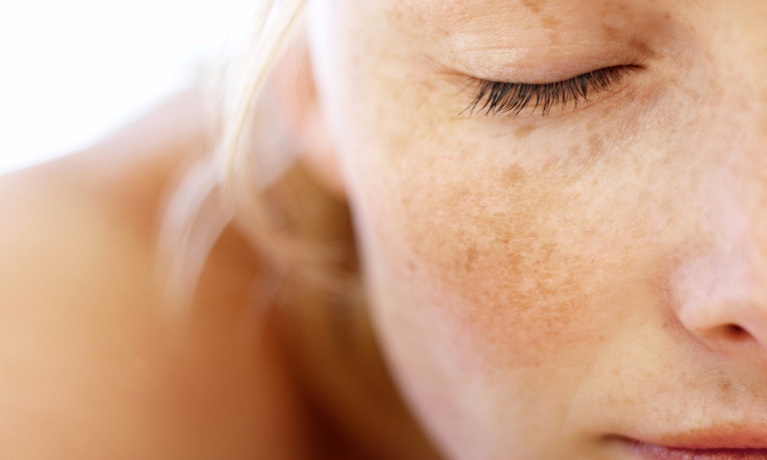Pesquisa: sem cura definitiva, melasma acomete de 15% a 35% das mulheres