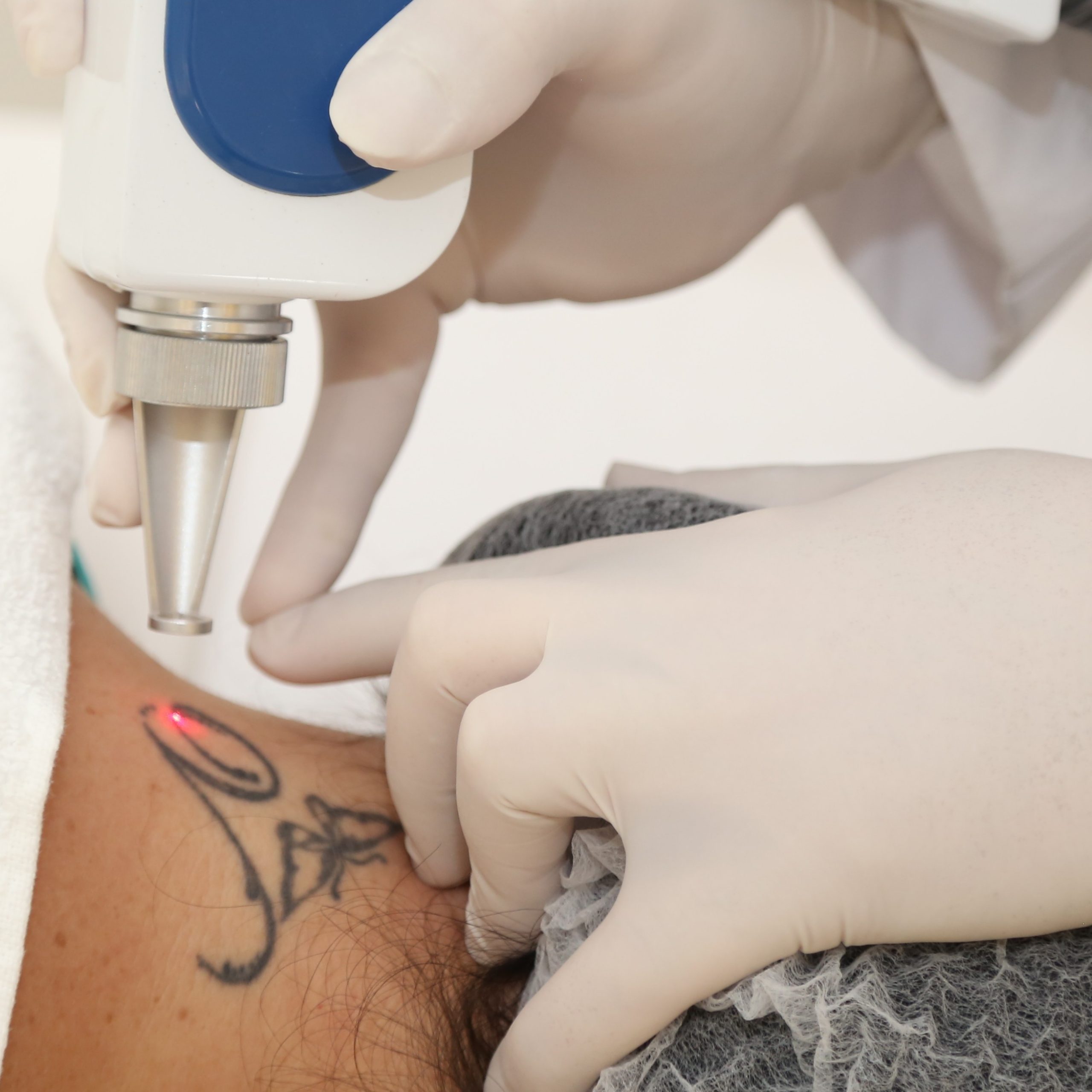 Novas técnicas fazem procura por remoção de tatuagem crescer em Franca