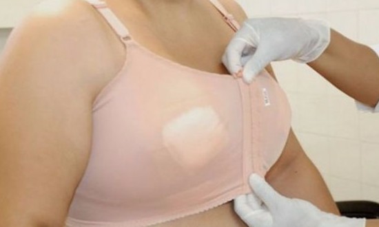 Mulheres com gigantismo de mama não têm como operar pelo SUS em Franca
