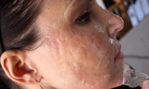 Peeling de fenol é alternativa para quem deseja “juventude” natural