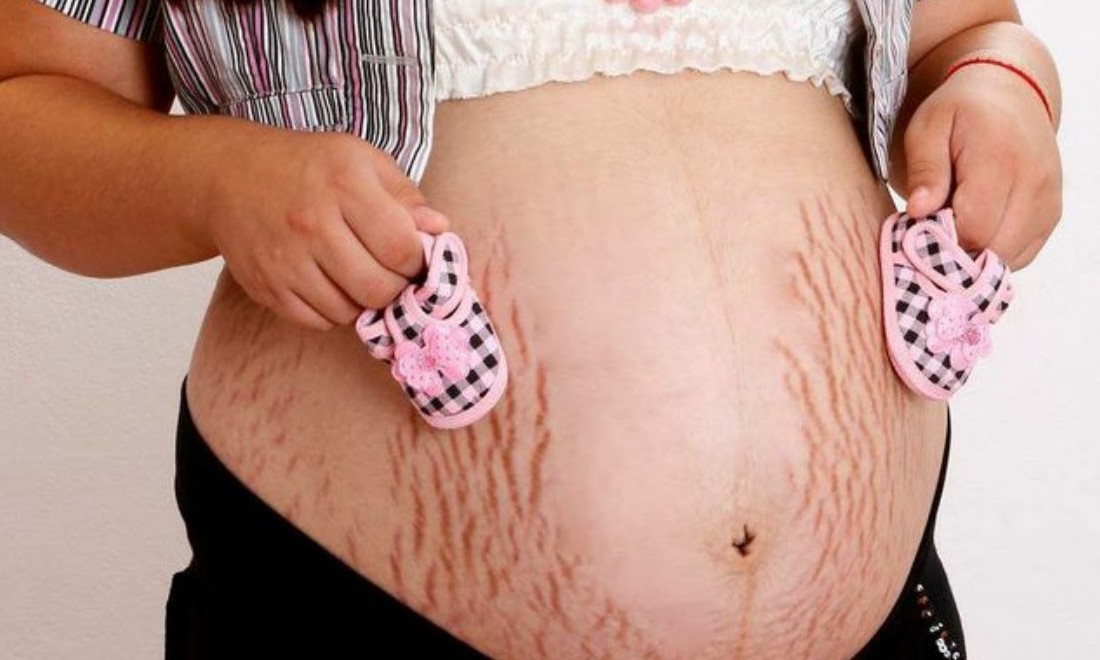 Dermatologista dá receita que bloqueia surgimento de estrias durante a gravidez