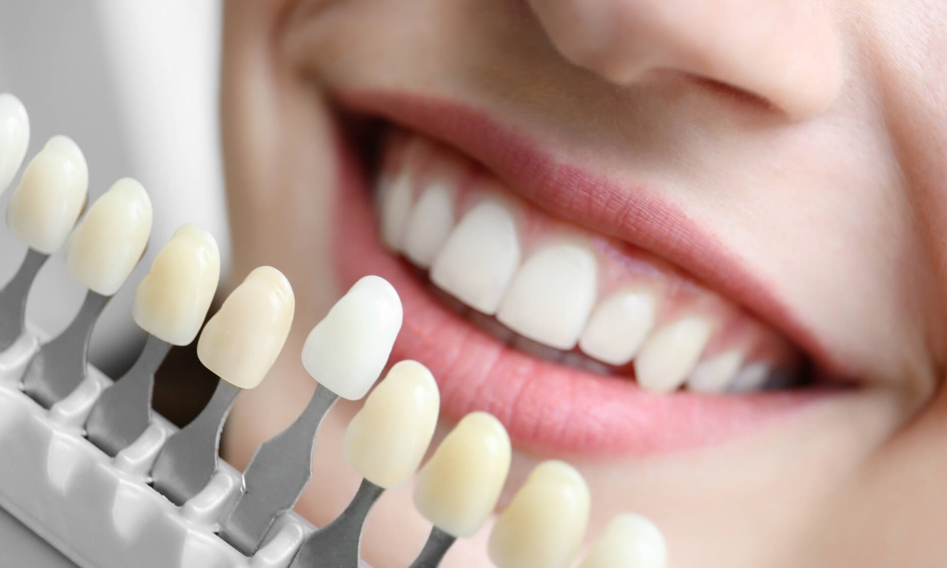 Lentes de contato dentárias são a promessa de sorriso perfeito
