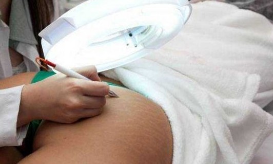Micropigmentação em estrias – o que é preciso saber antes de fazer