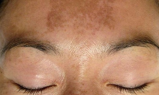 Sem cura definitiva, melasma chega a acometer de 15% a 35% das mulheres