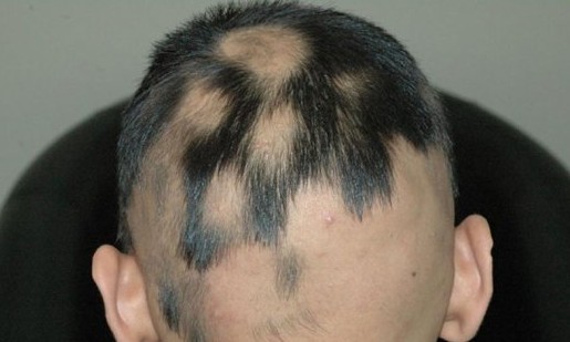 Alopecia areata afeta de 1% a 2% da população, com queda de pelos do corpo