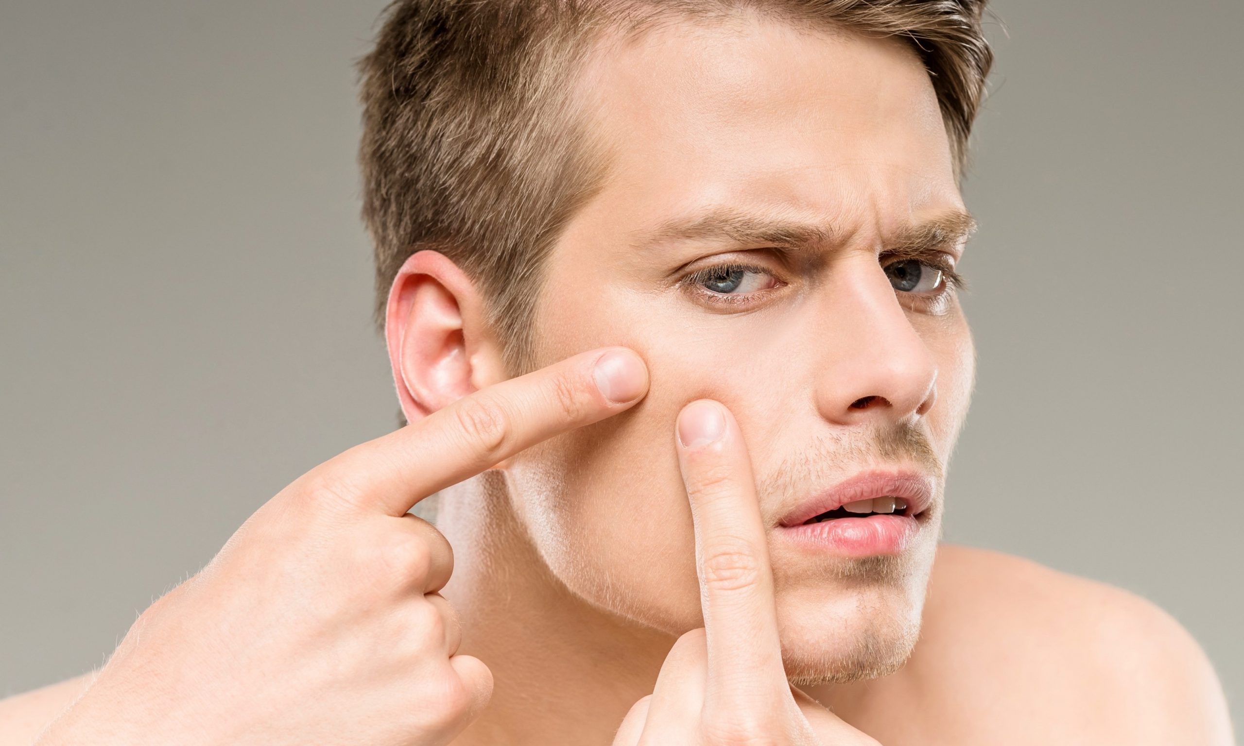 Conheça as causas e tratamentos para acne, muito comum em adultos