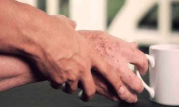 Remover apêndice reduz em 19% risco de Parkinson, aponta estudo