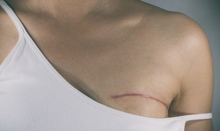 Lei garante reconstrução da mama para mulheres vítimas de câncer