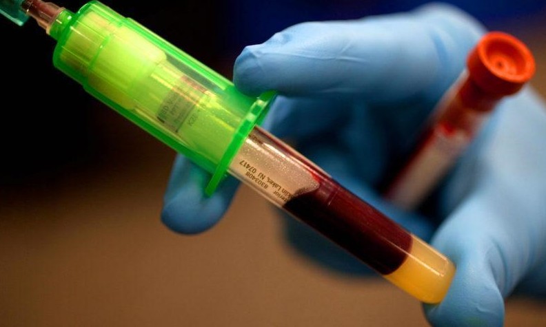 Exame de sangue pode acusar lesão pré-cancerígena no pulmão