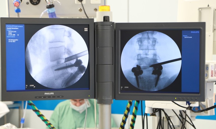USP estuda cirurgia na coluna por endoscopia que reduz recuperação