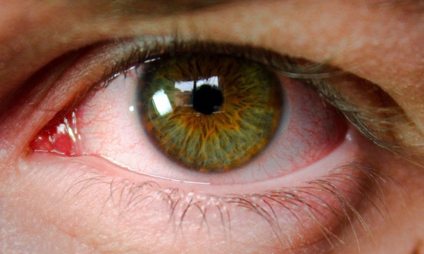 Principal causa da cegueira, glaucoma avança com envelhecimento
