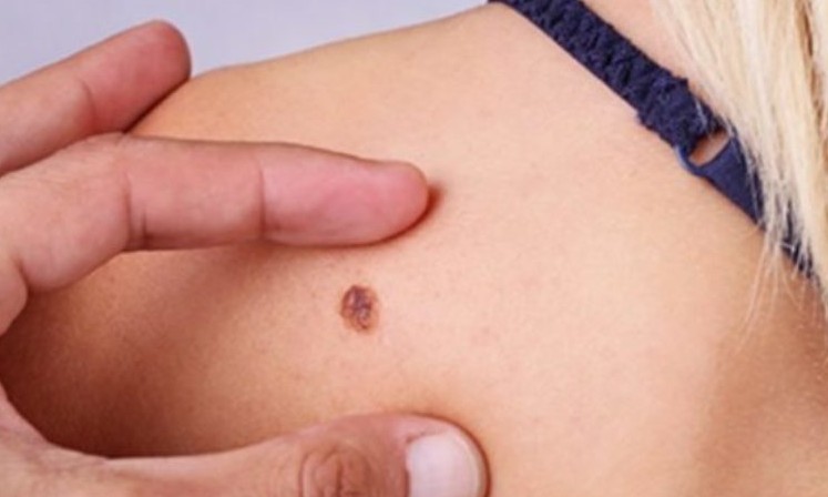 Manchas podem ser sinal de câncer de pele, que chega a 180 mil novos casos por ano