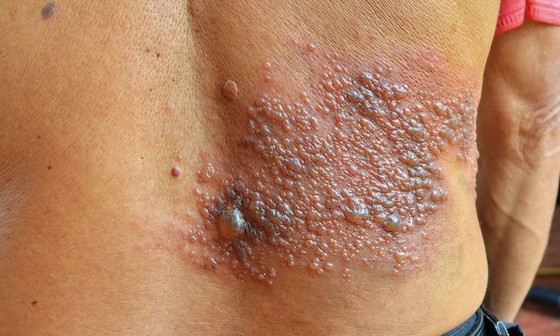 Vacina após os 50 anos evita o Herpes Zóster, doença extremamente desfigurante