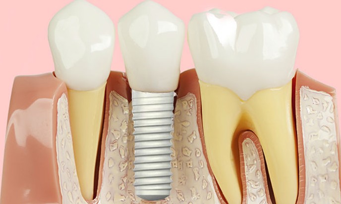 USP: pesquisa em Ribeirão Preto busca voluntários com implantes dentários