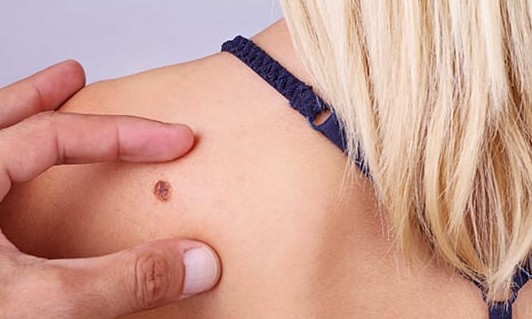 Melanoma: entenda o tipo de câncer que provocou a morte de Roberto Leal