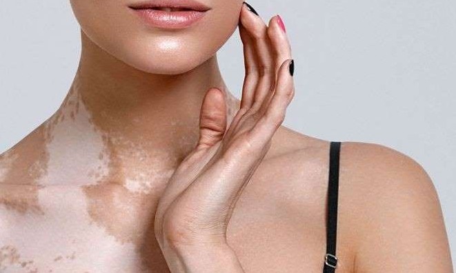 Você sabe como começa o vitiligo e quando ele pode ser emocional?