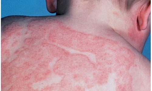 Desconhecida, dermatite atópica é crônica e incurável, mas pode ser controlada