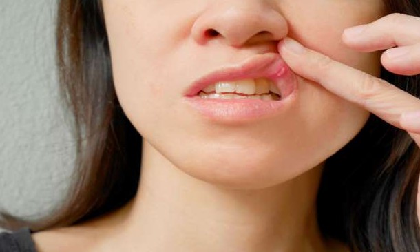 HPV aumenta os riscos de câncer de boca e garganta entre os mais jovens