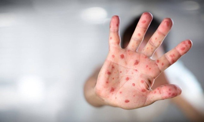 Brasil tem quase 13,5 mil casos confirmados de sarampo durante 2019