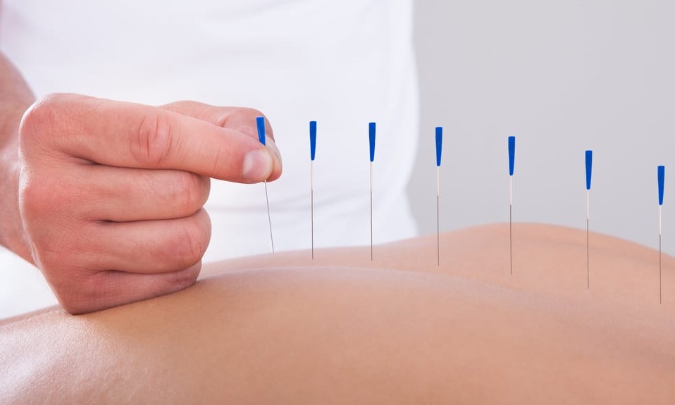 Supremo Tribunal Federal proíbe o fisioterapeuta de atuar como acupunturista