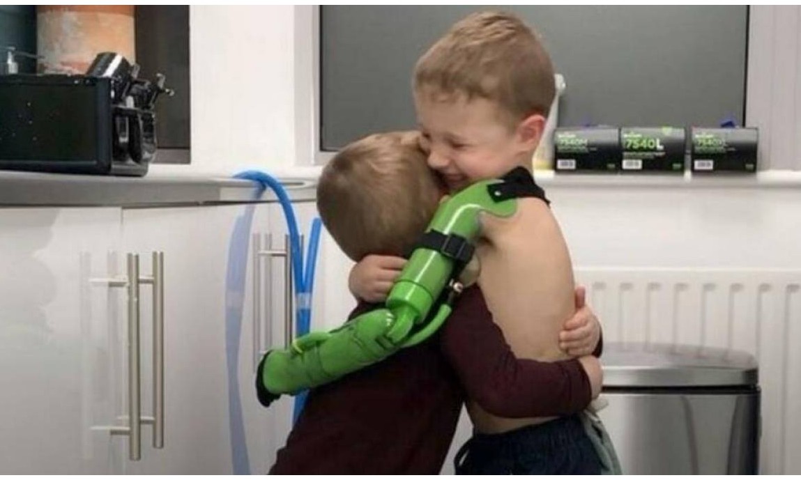 É de se emocionar: Menino abraça irmão pela primeira vez após ganhar prótese