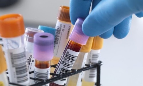 Exame de sangue pode prever o risco de uma pessoa ter Alzheimer
