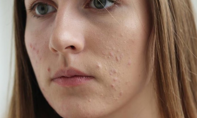 Saiba se a vitamina C pode realmente ajudar no tratamento contra a acne
