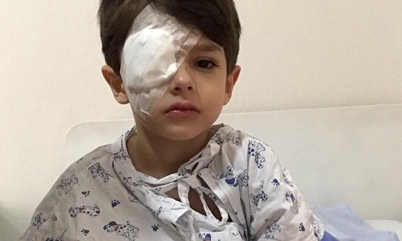 Mãe alerta sobre queimadura no olho do filho de 5 anos causada por álcool gel