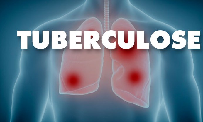 Campanha contra a tuberculose vai envolver a população de Franca