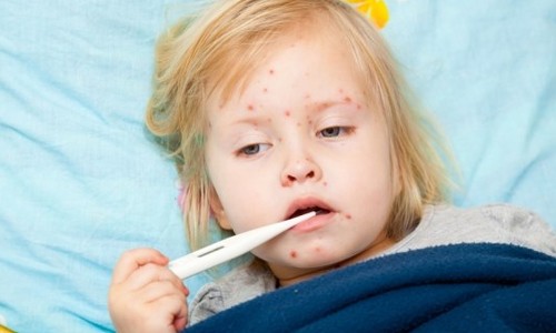 Chegada da primavera acende alerta para aumento de casos de catapora