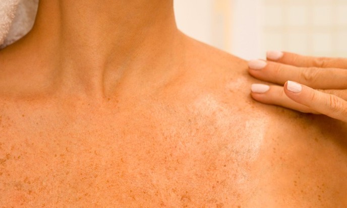 Especialista alerta para prevenção do câncer de pele com o forte calor