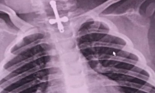 Menino de 2 anos engole crucifixo que é retirado após intervenção médica