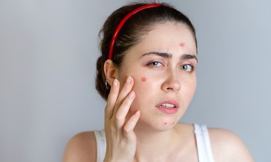 Acne nunca mais: conheça três soluções caseiras para acabar com o problema