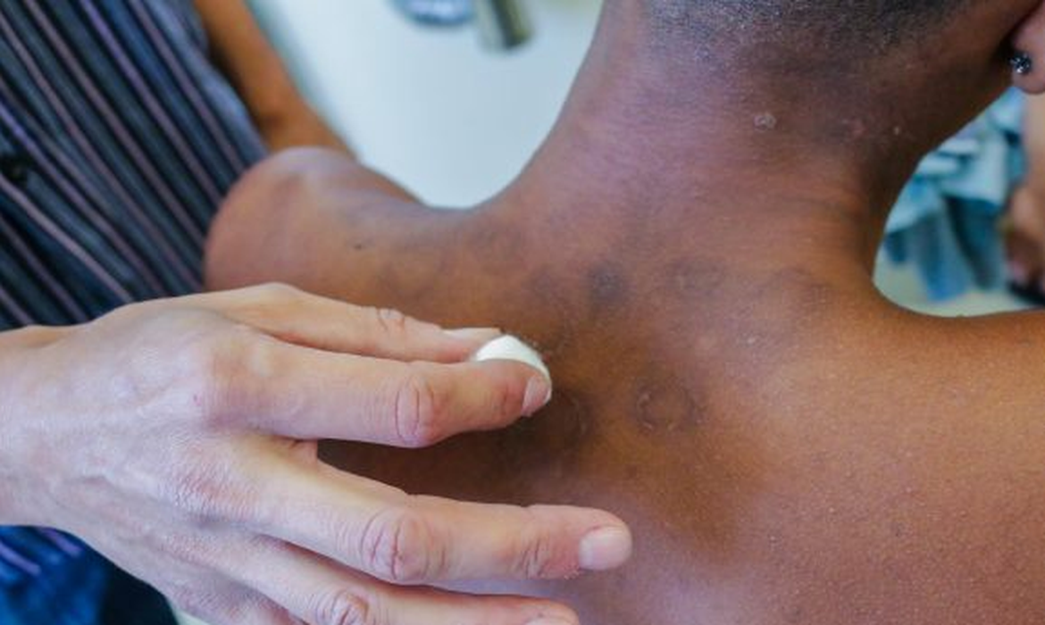 Brasil tem quase 30 mil novos casos de hanseníase por ano: é o segundo no ranking