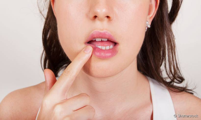 As aftas são pequenas lesões muito dolorosas que geralmente surgem na língua ou nos lábios