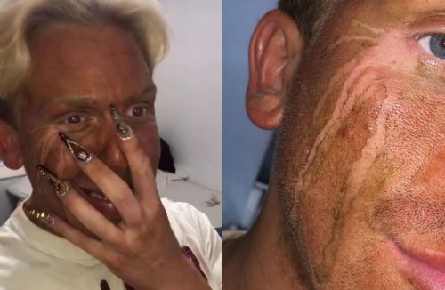 Deu ruim: jovem fica com o rosto todo manchado após chorar com autobronzeador - Jornal da Franca
