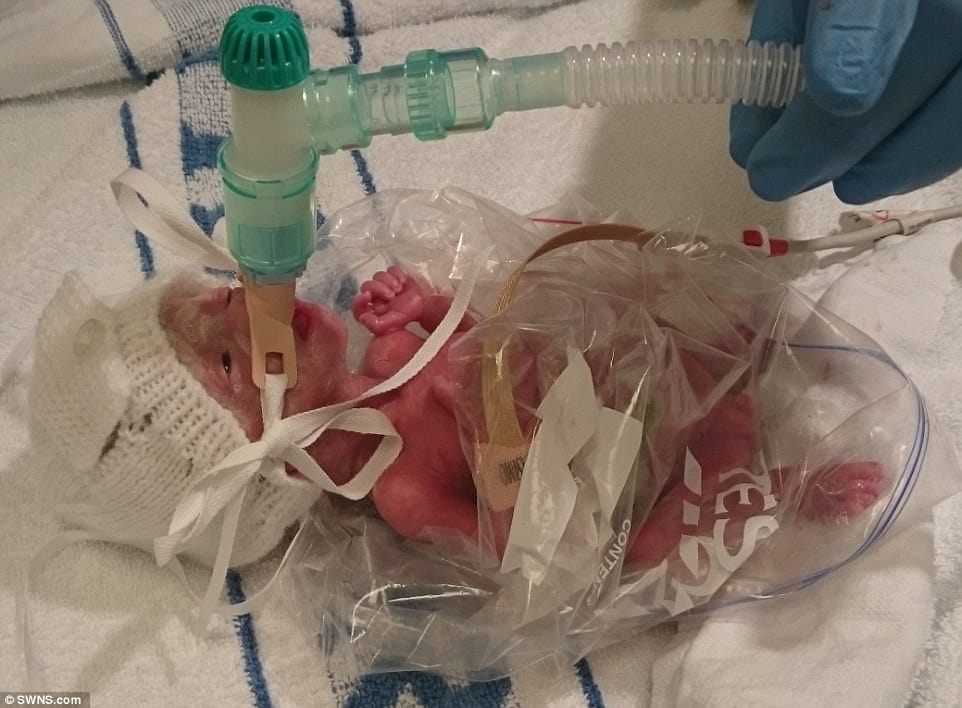 Médicos salvam vida de bebê prematura que nasceu de 27 semanas e com 490 gramas