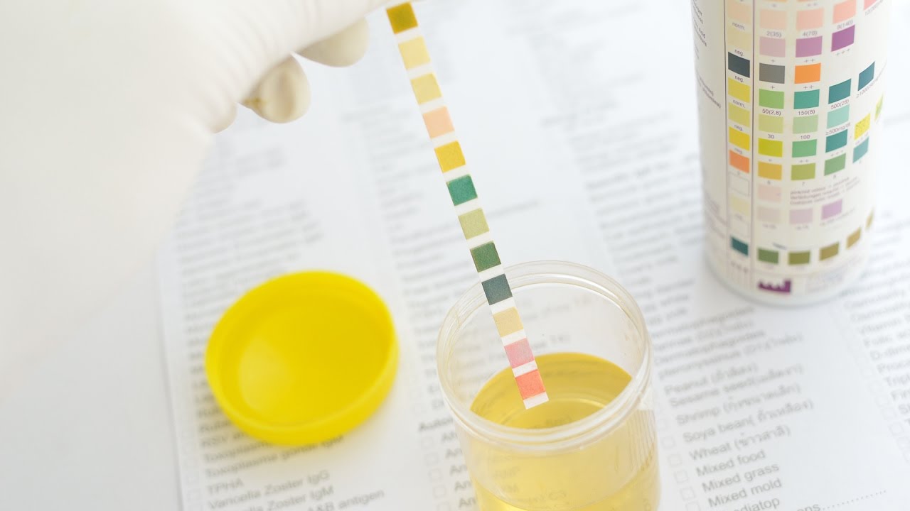 Estudos mostraram que exame de urina realizado por inteligência artificial detectou câncer com quase 100% de precisão