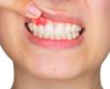 Saúde bucal: saiba o que a periodontite tem a ver com casos graves de Covid-19 - Jornal da Franca
